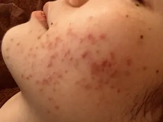 ニキビ/肌質改善専門 Snow skinのエステ・リラクイメージ