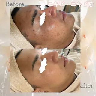 ニキビ&跡改善サロン オーナー光木のエステ・リラクイメージ