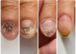 深爪矯正専門サロン　リュリュ所属・深爪矯正専門サロン リュリュのネイルデザイン