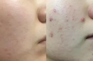 夏までに肌荒れ卒業 するサロン🌻のエステ・リラクイメージ