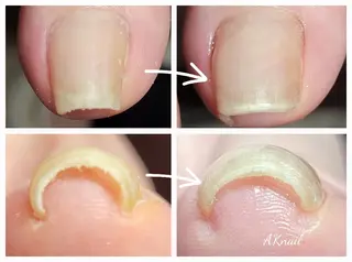 ネイル&巻き爪サロン 　AKnailのネイルデザイン