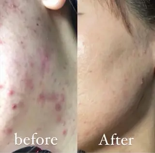 肌質改善|美眉サロンCannone'所属・肌質改善|美眉サロン Cannone’のエステ・リラクイメージ