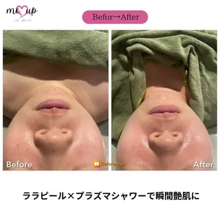 Meupニキビ専門店 背中/ハーブ/肌管理のその他イメージ