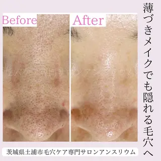 毛穴ケア専門サロンアンスリウム所属・茨城土浦 つくば毛穴 ケア専門サロンのエステ・リラクイメージ