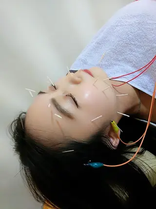 リフトアップ・たるみ ☆美容鍼小顔矯正のその他イメージ