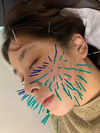 表参道鍼灸院K 美容鍼🔮ララピールのエステ・リラクイメージ