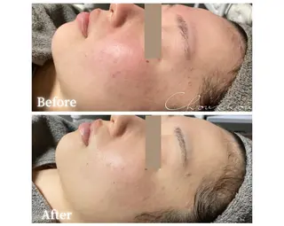 beauty & health salon Chou chou所属・ニキビ・毛穴🌿肌を 育てるララピール✨のエステ・リラクイメージ