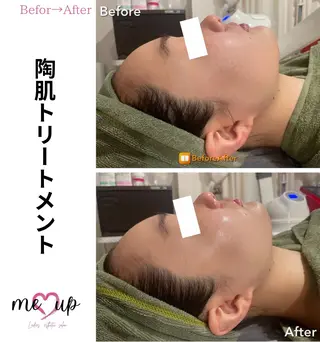 Meupニキビ専門店 背中/ハーブ/肌管理のその他イメージ