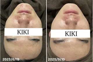 ハーブピーリング 綺肌-KIKI- 銀座店所属・🌿‬ハーブKIKI sawako🌿‬のエステ・リラクイメージ