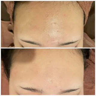 ニキビ特化型エステ 🍓最短で肌質改善のエステ・リラクイメージ