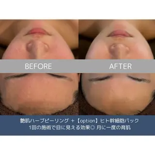 himee所属・艶肌ハーブピーリング /毛穴洗浄のエステ・リラクイメージ