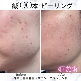 美容鍼・小顔矯正 ハリシェンドのエステ・リラクイメージ