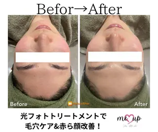 Meupニキビ専門店 背中/ハーブ/肌管理のその他イメージ