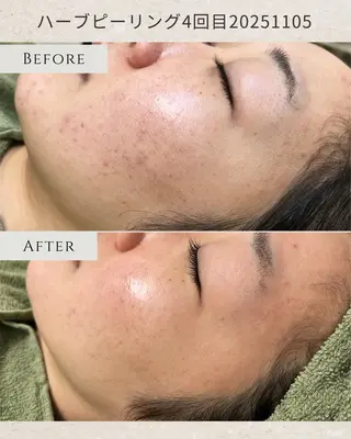 シミ毛穴|眉Wax THE  flowのエステ・リラクイメージ