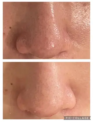 6万人の美肌実績🔥 最短ニキビ改善のエステ・リラクイメージ