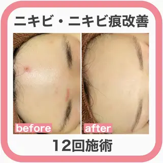 ニキビ跡改善専門🔥 医療にはできない改善のエステ・リラクイメージ