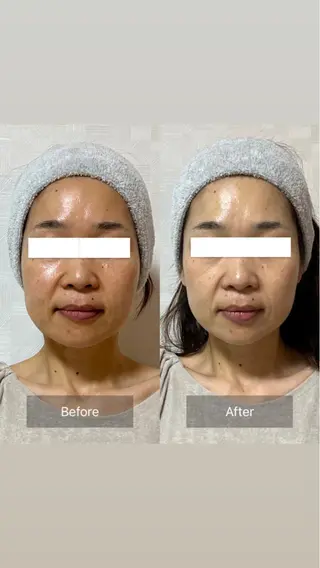 本気の小顔×毛穴ケア ／もりやま はるかのエステ・リラクイメージ