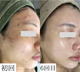 韓国美肌/肌質改善 【天神】yuiのエステ・リラクイメージ