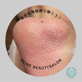 Reine BeautySalon所属・毛穴/シミ肝斑/脱毛 横山梨里のエステ・リラクイメージ