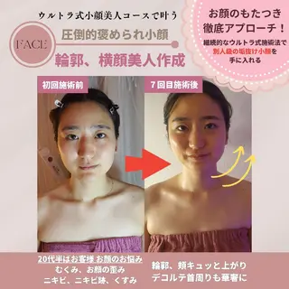 痩身ハーブピーリング 筋膜リリース☆B&Hのエステ・リラクイメージ