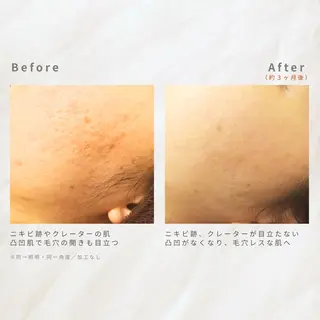 繰り返すニキビを改善 ✨つくば肌質改善専門のエステ・リラクイメージ