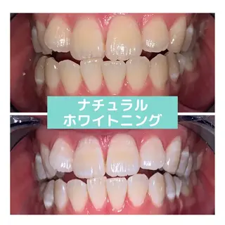 ホワイトニング|韓国式3D毛穴洗浄 lonhana ロンハナ所属・韓国式3D毛穴洗浄 lonhanaのその他イメージ