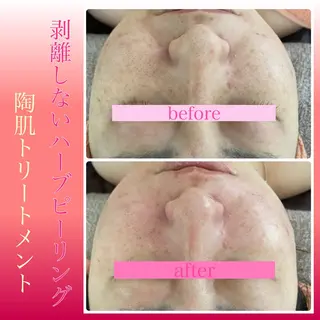 Chalon所属・REVI取扱・肌悩み 毛穴Chalonのエステ・リラクイメージ