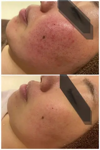 ニキビ跡改善専門🔥 医療にはできない改善のエステ・リラクイメージ