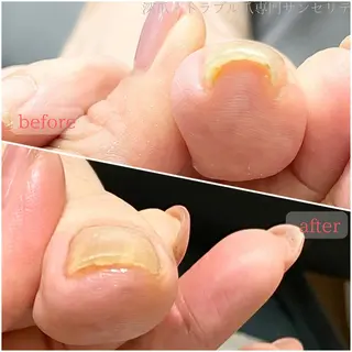 ネイル 深爪・巻き爪 専門サンセリテのネイルデザイン