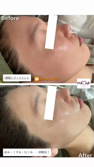 Meupニキビ専門店 背中/ハーブ/肌管理のその他イメージ