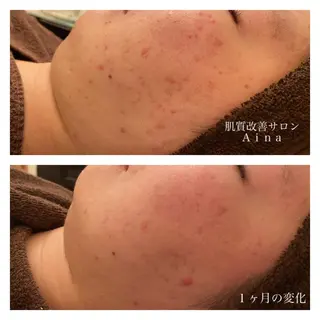 ミディアム カラー パーマ ヘアアレンジ メンズ キッズ ネイル マツエク・マツパ ニキビ跡専門サロン Ainaのエステ・リラクイメージ