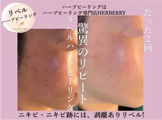 ハーブピーリング専門店HERBERRY難波心斎橋店所属・ハーブピーリング専門 HERBERRY冨永のエステ・リラクイメージ