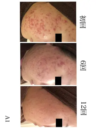 ショート カラー パーマ ヘアアレンジ メンズ キッズ ネイル マツエク・マツパ アイブロウ 夏までに肌荒れ卒業 するサロン🌻のエステ・リラクイメージ