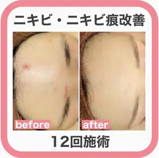 学生ニキビ改善🍀 優しい肌質改善のエステ・リラクイメージ
