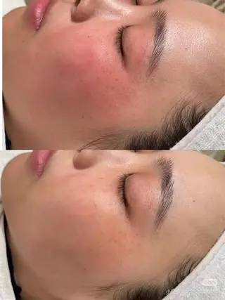 パーマ aliaハイフ&水光ジェットサロン所属・aliaハーブ水光店 エステティシャン募集のエステ・リラクイメージ