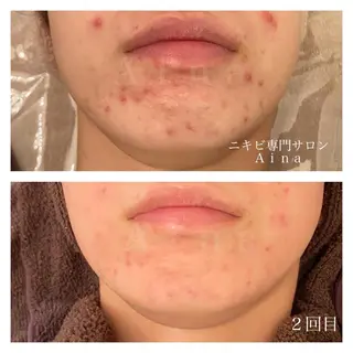 ショート パーマ ヘアアレンジ メンズ キッズ ネイル マツエク・マツパ アイブロウ ニキビ跡専門サロン Ａｉｎａのエステ・リラクイメージ