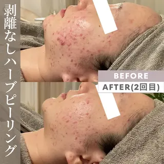 Lupure(ルプレ)所属・美肌サロン💎ハーブ ピーリング🌿ルプレのエステ・リラクイメージ