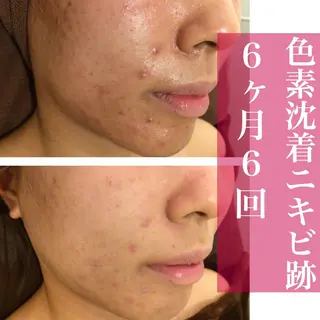 ミディアム カラー パーマ ヘアアレンジ メンズ キッズ ネイル マツエク・マツパ アイブロウ ニキビ・肌質改善専門 ♡人生が変わるサロンのエステ・リラクイメージ