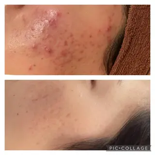 ミディアム カラー パーマ ヘアアレンジ メンズ キッズ ネイル マツエク・マツパ アイブロウ ニキビ特化型エステ 🍓最短で肌質改善のエステ・リラクイメージ