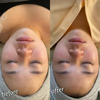 うなじ脱毛/美肌脱毛 LABELのエステ・リラクイメージ