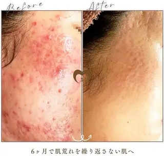 ニキビケア/毛穴/ 赤み/自信の肌✨森園のエステ・リラクイメージ