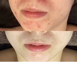 池袋ニキビ毛穴改善 🌿ハーブピーリングのエステ・リラクイメージ