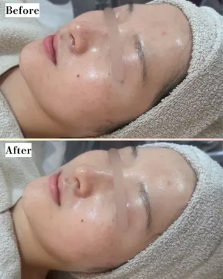 |ピーリング・毛穴| soina神楽坂のエステ・リラクイメージ