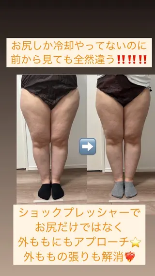 Miiju.所属・Miiju. 石巻市 脂肪冷却  鈴木のエステ・リラクイメージ