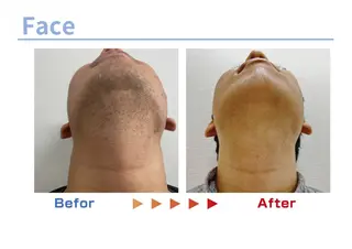 セルフ脱毛/美尻イス キングスサロン熊本のエステ・リラクイメージ