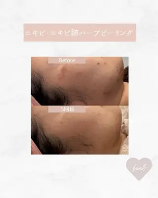 べアール所属・小顔/毛穴/ニキビ salon bealのエステ・リラクイメージ