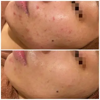 セミロング カラー パーマ ヘアアレンジ メンズ キッズ ネイル マツエク・マツパ アイブロウ ニキビ特化型エステ 🍓最短で肌質改善のエステ・リラクイメージ