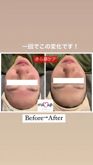 Meupニキビ専門店 背中/ハーブ/肌管理のその他イメージ