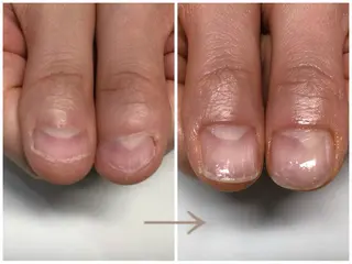 ネイル 深爪矯正・自爪育成 ヴェールリムのネイルデザイン