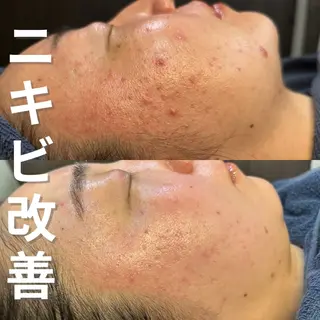 ニキビ・ニキビ跡改善 leoloのエステ・リラクイメージ